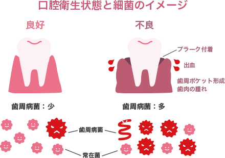 口腔衛生状態と細菌のイメージ良好不良プラーク付着出血歯周ポケット生成歯肉の腫れ歯周病菌：少歯周病菌：多歯周病菌常在菌