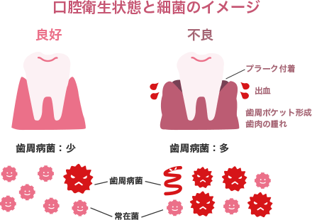口腔衛生状態と細菌のイメージ良好不良プラーク付着出血歯周ポケット生成歯肉の腫れ歯周病菌:少歯周病菌:多歯周病菌常在菌
