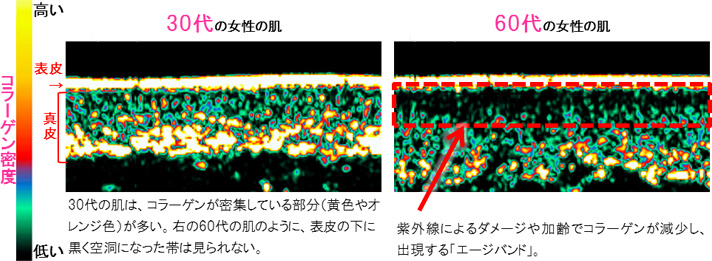 コラーゲン密度高い低い表皮真皮30代の女性の肌30代の肌は、コラーゲンが密集している部分（黄色やオレンジ色）が多い。右の60代の肌のように、表皮の下に黒く空洞になった帯は見られない。60代の女性の肌紫外線によるダメージや加齢でコラーゲンが減少し、出現する「エージバンド」。